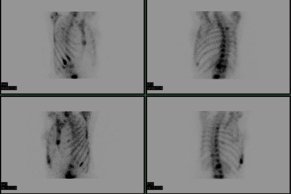 Bone scan Metastasis0001